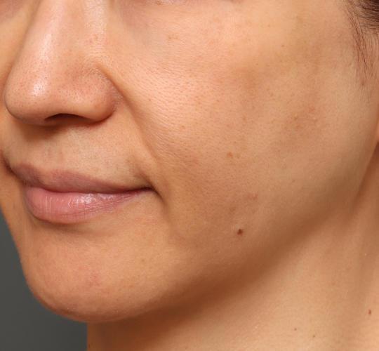50代女性のシミ・そばかす Before 症例写真