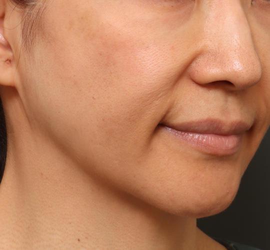 50代女性のグロウHIFUセレクトプラス Before 症例写真