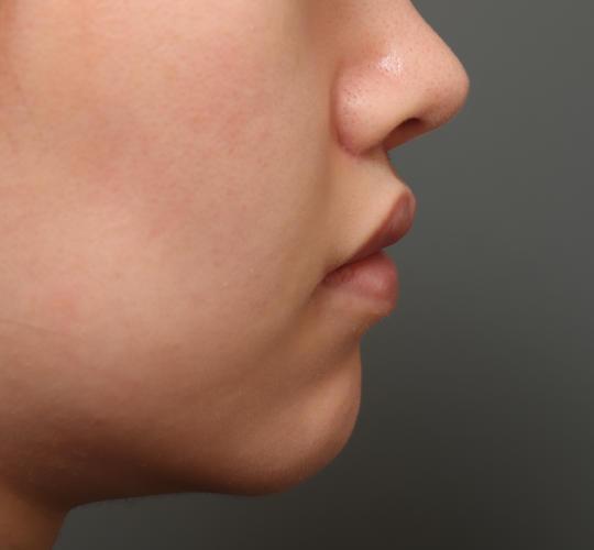 20代女性の人中短縮（リップリフト） After 症例写真