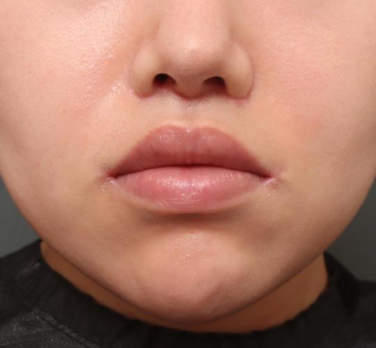 20代女性の人中短縮（リップリフト） After 症例写真