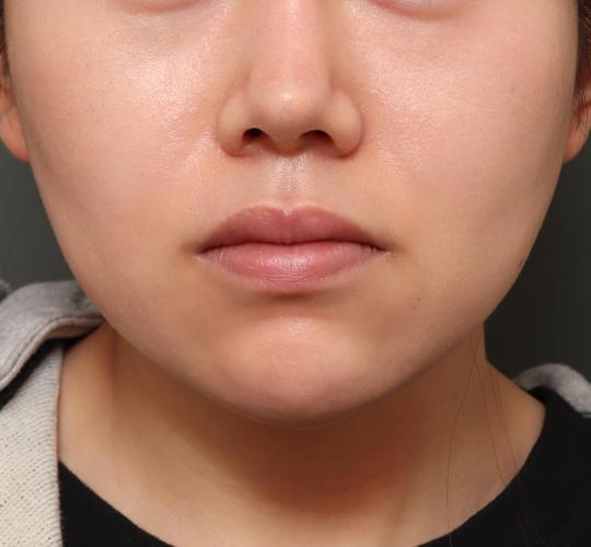 20代女性の唇・口元の整形 Before 症例写真