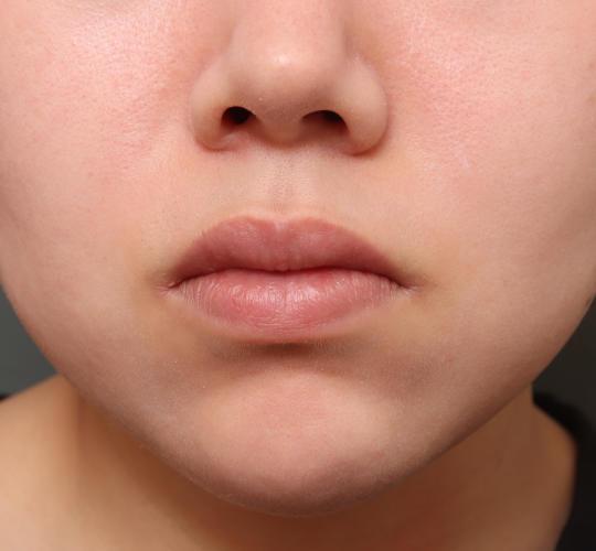 20代女性の人中短縮（リップリフト） Before 症例写真