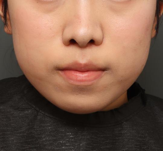 10代女性の唇・口元の整形 After 症例写真