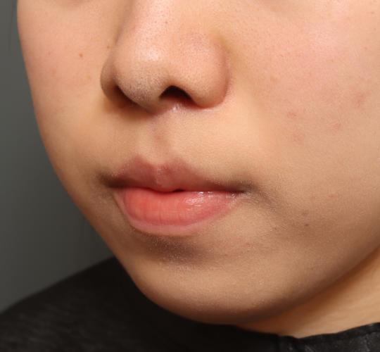 10代女性の人中短縮（リップリフト） After 症例写真