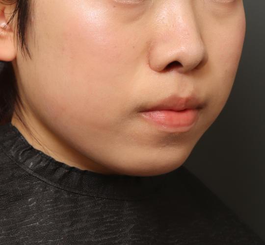 10代女性の人中短縮（リップリフト） After 症例写真