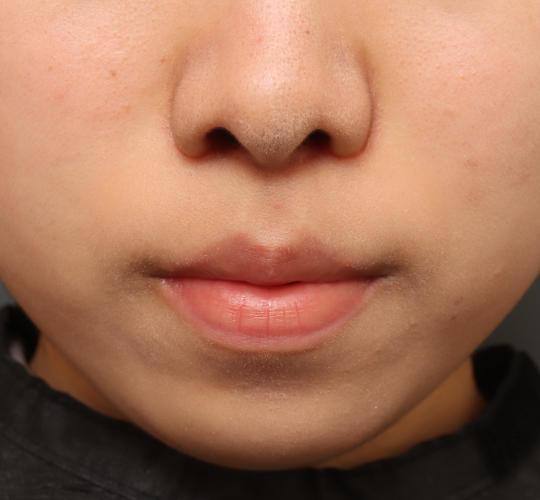 10代女性の人中短縮（リップリフト） After 症例写真