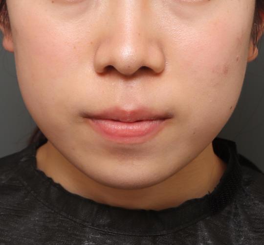 10代女性の唇・口元の整形 Before 症例写真