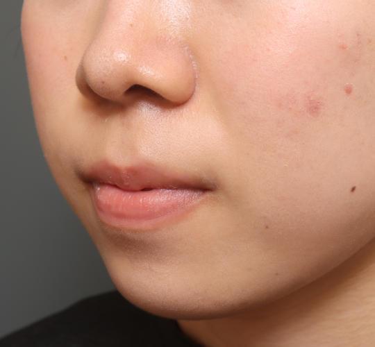 10代女性の人中短縮（リップリフト） Before 症例写真