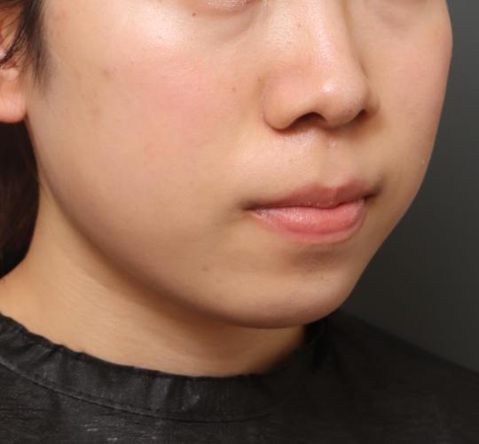 10代女性の人中短縮（リップリフト） Before 症例写真