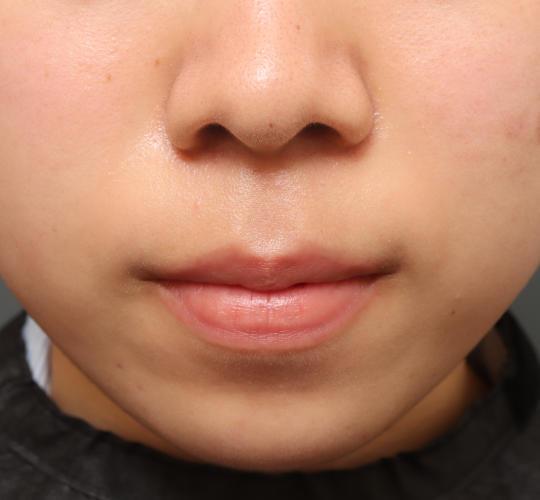 10代女性の人中短縮（リップリフト） Before 症例写真