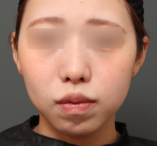 20代女性の唇・口元の整形 After 症例写真