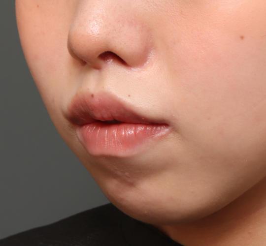 20代女性の人中短縮（リップリフト） After 症例写真