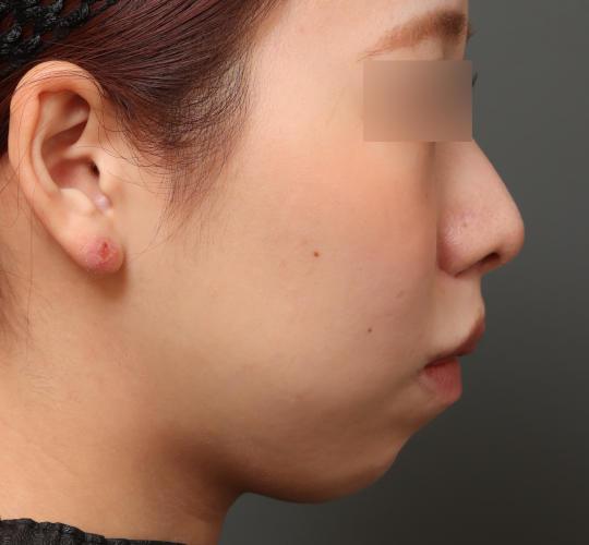 20代女性の人中短縮（リップリフト） After 症例写真