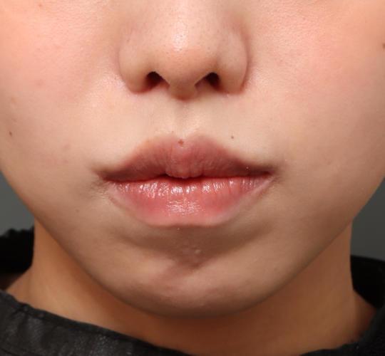 20代女性の人中短縮（リップリフト） After 症例写真