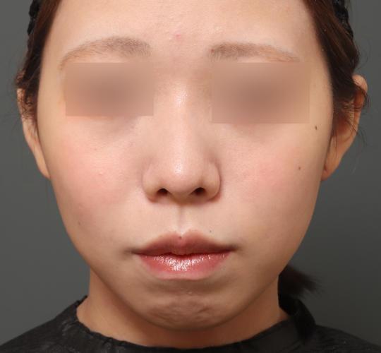 20代女性の唇・口元の整形 Before 症例写真