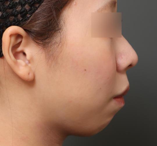 20代女性の人中短縮（リップリフト） Before 症例写真