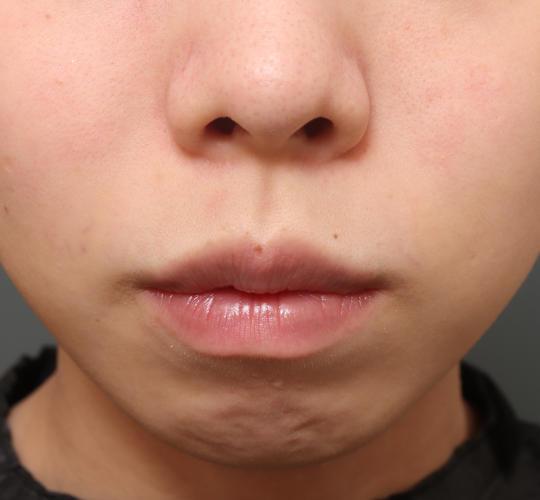 20代女性の人中短縮（リップリフト） Before 症例写真