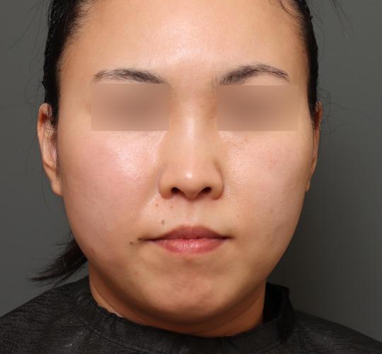 30代女性の耳介軟骨移植 After 症例写真