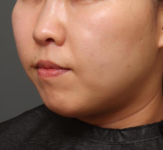 30代女性の耳介軟骨移植 After 症例写真