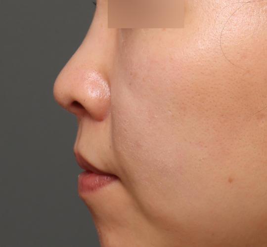 30代女性の耳介軟骨移植 After 症例写真