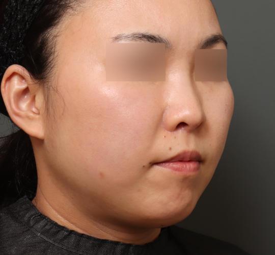 30代女性の耳介軟骨移植 After 症例写真