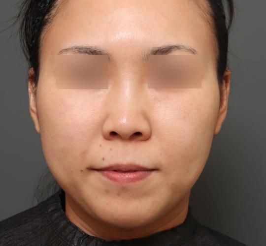 30代女性の耳介軟骨移植 Before 症例写真