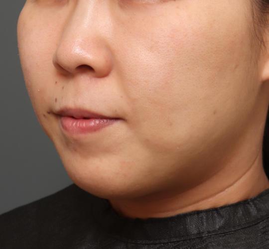 30代女性の耳介軟骨移植 Before 症例写真