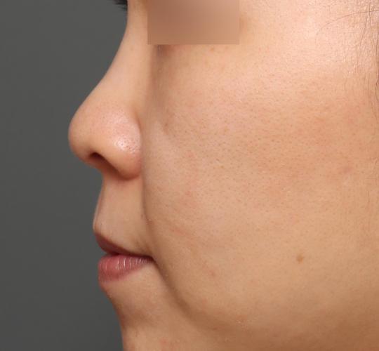 30代女性の耳介軟骨移植 Before 症例写真
