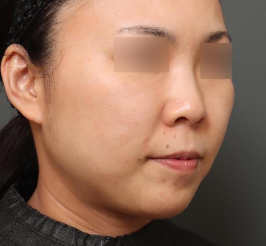 30代女性の耳介軟骨移植 Before 症例写真