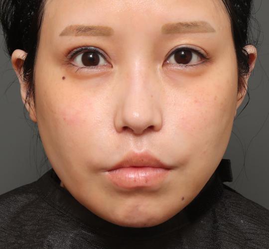 30代女性の唇・口元の整形 After 症例写真