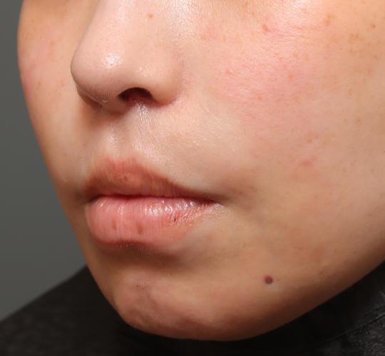 30代女性の人中短縮（リップリフト） After 症例写真