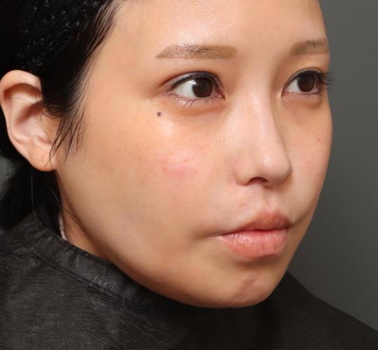 30代女性の人中短縮（リップリフト） After 症例写真