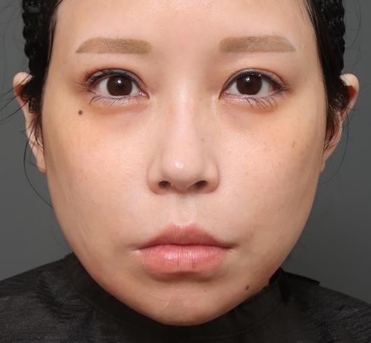 30代女性の唇・口元の整形 Before 症例写真