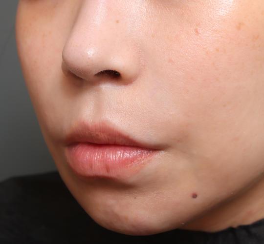 30代女性の人中短縮（リップリフト） Before 症例写真
