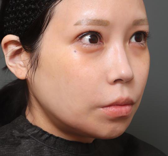 30代女性の人中短縮（リップリフト） Before 症例写真
