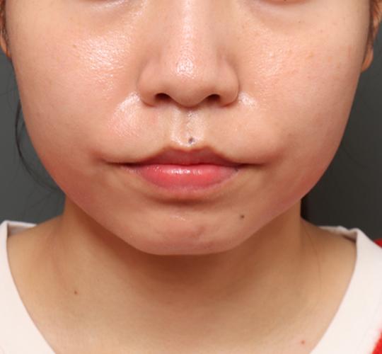 20代女性の鼻の整形 After 症例写真