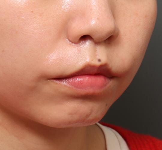 20代女性の人中短縮(リップリフト) After 症例写真