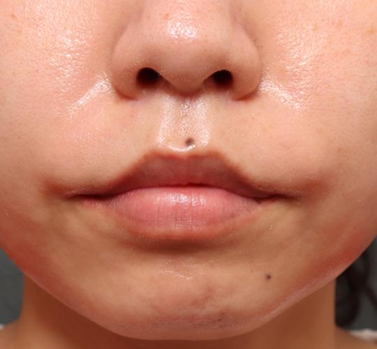 20代女性の人中短縮(リップリフト) After 症例写真