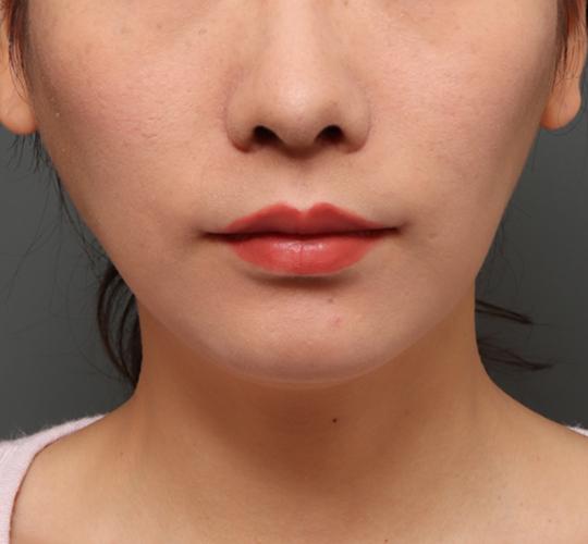 20代女性の人中短縮（リップリフト） After 症例写真