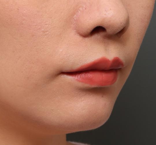 20代女性の人中短縮(リップリフト) After 症例写真