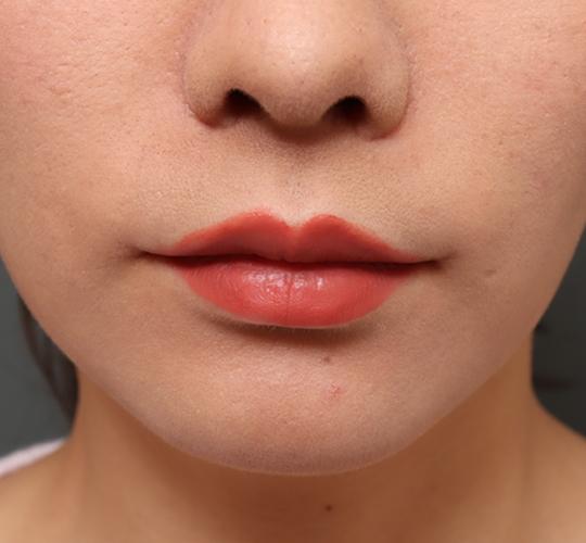 20代女性の人中短縮(リップリフト) After 症例写真