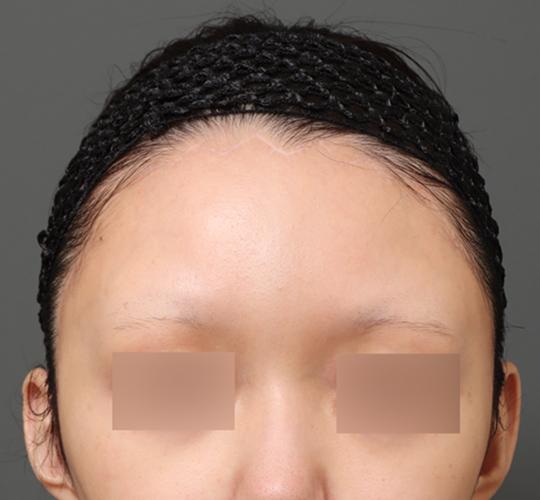 20代女性の額縮小 After 症例写真
