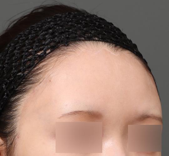 20代女性の額縮小 After 症例写真