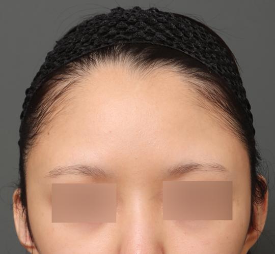 20代女性の額縮小 Before 症例写真