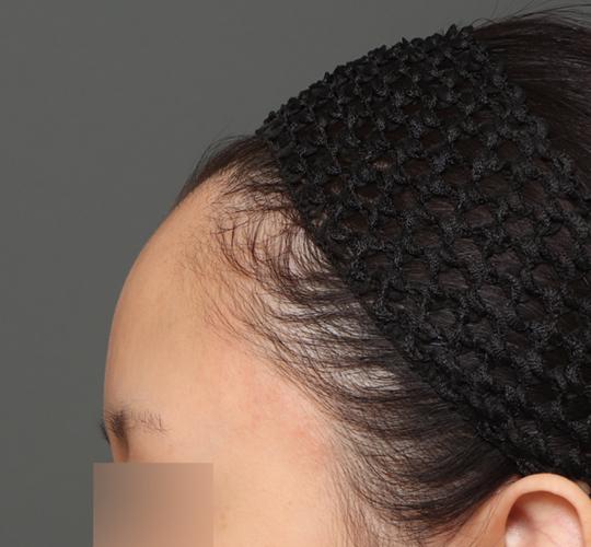 20代女性の額縮小 Before 症例写真