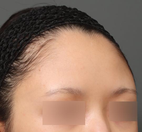 20代女性の額縮小 Before 症例写真