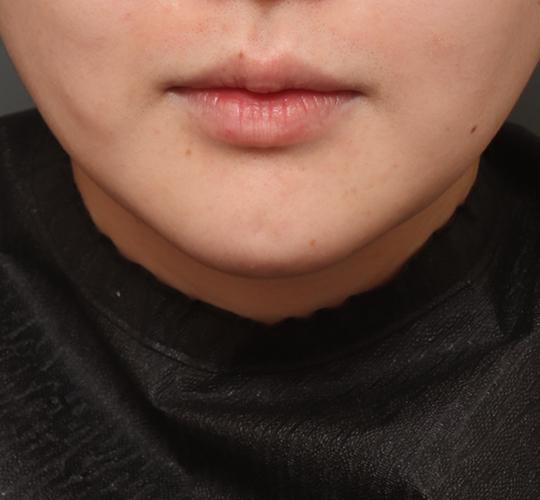 20代女性の二重アゴ筋肉縛り（ペリカン手術） After 症例写真