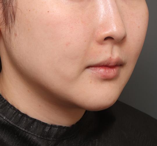 20代女性の二重アゴ筋肉縛り（ペリカン手術） After 症例写真