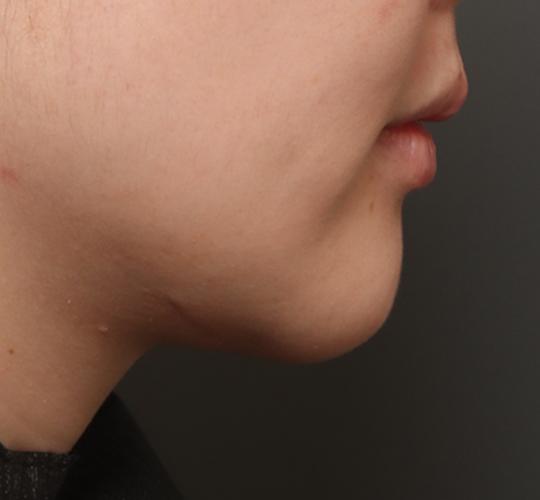 20代女性の二重アゴ筋肉縛り（ペリカン手術） After 症例写真