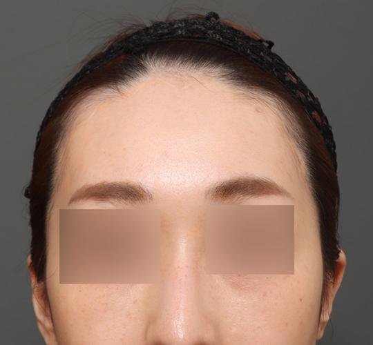 30代女性のエラ・アゴ・小顔 After 症例写真